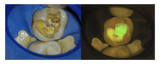 FlexionCam-Treatment